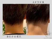 エープラス 心斎橋店(A+)/ひげうな脱毛