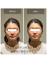 ロッタ エクリュ(Lotta ecru+)/一度で効果を実感！小顔矯正