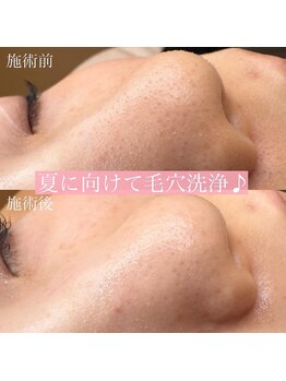 リンド エステ まつげ 京成大久保(Lind)/夏に向けて毛穴洗浄