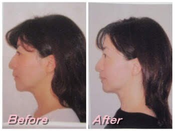 ドクター ヴィーナス/横顔美人に！お肌のトーンアップ