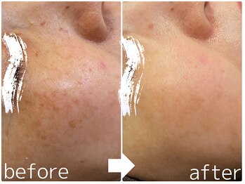 ラピュール(RaPur)/ホワイトニングケア