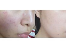 セルフエステBB あけのアクロス店/敏感肌の方へ