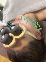 ラムールボーテ(L'AMOUR BEAUTE)/美眼灸