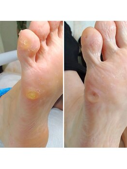 ドクターネイル爪革命 小田原鴨宮店/タコ・魚の目ケア