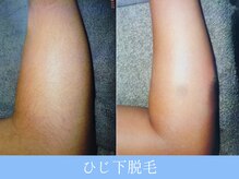オーシャンブルー 大分店(OCEAN BLUE)/ひじ下脱毛