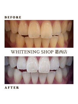 ホワイトニングショップ 葛西店/歯科提携 ホワイトニング専門店