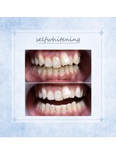 ソレラ(sorelle)/セルフホワイトニング