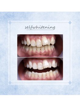 ソレラ(sorelle)/セルフホワイトニング