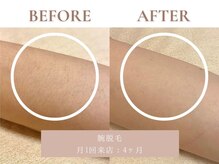 サエラ(SAERA)/腕脱毛【4回】