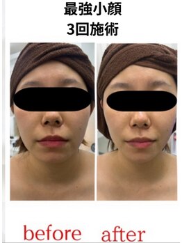 ステラ(Stella)/小顔3回でスッキリ