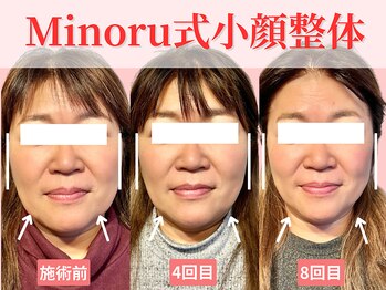 フレキシボディ(FlexiBody)/小顔施術ビフォーアフター #2