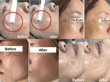 エルア 尼崎(Elua)の雰囲気（シミ専用ハーブピーリングで、エイジングサインを徹底ケア♪）