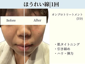 京都フォーエイチ(京都4H)/ほうれい線|施術1回|5分