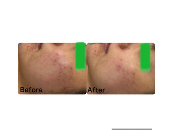 マーレン(Malen)/【クリスティーナ症例写真】