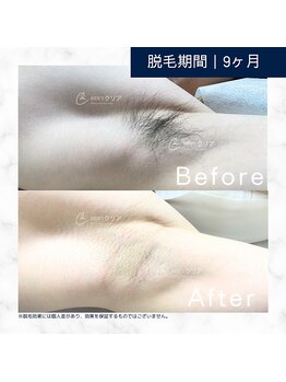 メンズクリア いわき店/【メンズクリア】お客様の施術例