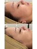 脱毛ダントツ人気★当日から輝く美白！顔脱毛★1回￥6,600→￥3,300