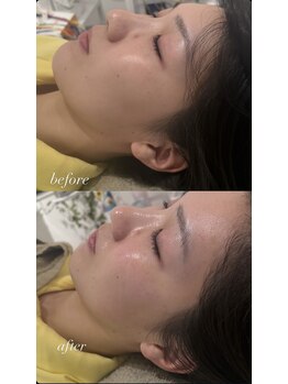 マホロバ(mahoroba)/ダーマ鍼+幹細胞導入+美容鍼