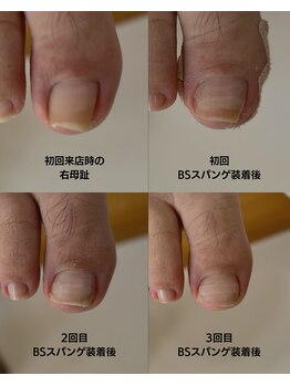 おん/巻き爪補正の経過記録(右母趾)