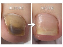 巻き爪補正店 金山店/肥厚爪（初回と１年２カ月後）