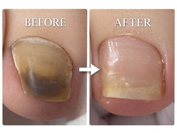 巻き爪補正店 金山店/肥厚爪（初回と１年２カ月後）