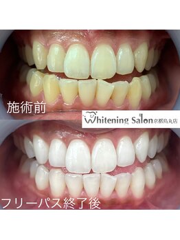 ホワイトニングサロン 京都烏丸店/ホワイトニングサロン施術例