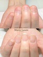 マリーロール 梅田店(Marie Laure)/自爪育成/深爪矯正/ネイルケア