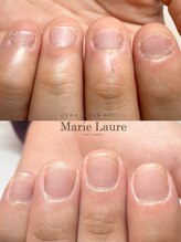 マリーロール 梅田店(Marie Laure)/自爪育成/深爪矯正/ネイルケア