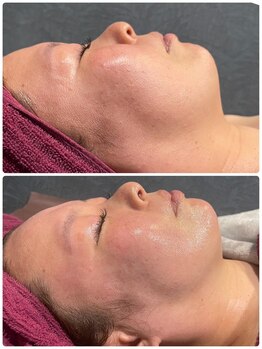 サロンドエテ(salon de ete)/毛穴引き締めリフトアップで小顔