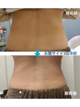 ルアナ(Luana)/埼玉初上陸！脂肪冷却ダイエット