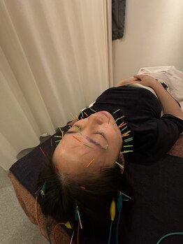 ジェイペック鍼灸整骨院/美容鍼スタンダードコース