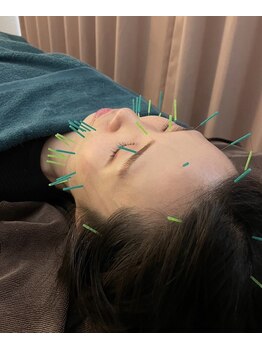 たんぽぽ整骨院鍼灸院/美容はり施術♪