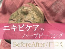 ベアール(beal)/終わりのあるニキビケア根本改善