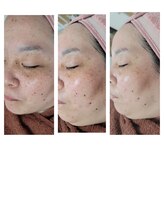 エスボーテ(sbeaute)/プラズマ+ダクトピール