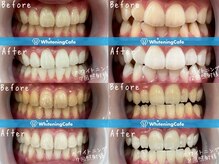 ホワイトニングカフェ 仙台店(WhiteningCafe)