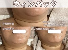 ポレ サロ(pore salo)/【ウィンバック｜たるみケア】