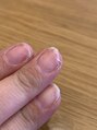 グリッター(glitter)&nbsp;元々爪が薄く、手荒れもありました。育成ケアで乗り越えました！