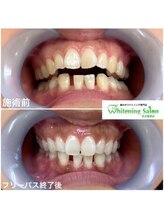 ホワイトニングサロン 名古屋駅店/【ホワイトニング施術例】