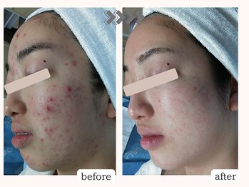 りりあす/お肌は必ず変わってくれます♪