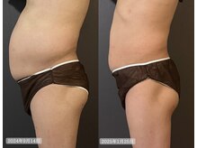 サロンドカメリア(salon de Camellia)/2.５ヶ月でー14kg！