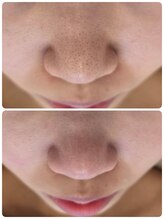 サロンド シェリー(Salon de Cherie)/気になる毛穴の詰まりに！！