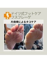 フスフレーゲ 学芸大学店/片麻痺によるタコケアのお悩み