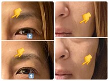 サロン ド ジョワ(salon de joie)/シワ改善/むくみ目解消！