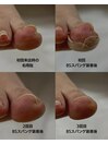 巻き爪補正の経過記録(右母趾)