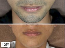 メンズ脱毛サロンChic 【シック】　南風原店の雰囲気（個室にて施術いたします♪）