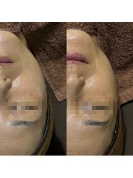 ミヨン(Miyong)/フェイスラインすっきり!