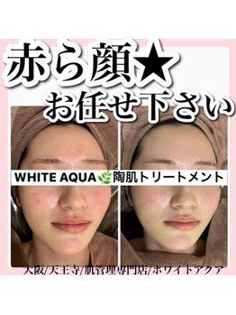 ホワイトアクア 天王寺本店(WHITE AQUA)/ハーブピーリング/大阪/天王寺