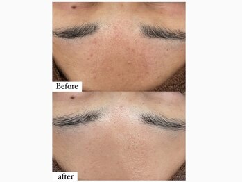 アワピール 成田公津の杜店(AWA PEELL)/ハーブピーリングで/公津の杜