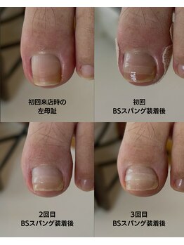 おん/巻き爪補正の経過記録(左母趾)