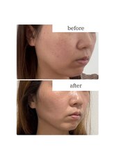 ユウドット(yuu.)/脂肪の分解レモンボトル