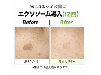 アプロ(Aphro)/シミ改善透明肌